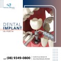Dental Implant in Balcatta Perth - Dentist in Perth - All on 4 Dental Implant